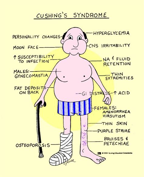 cushing's syndrome reddit|cushing syndrome nhs.